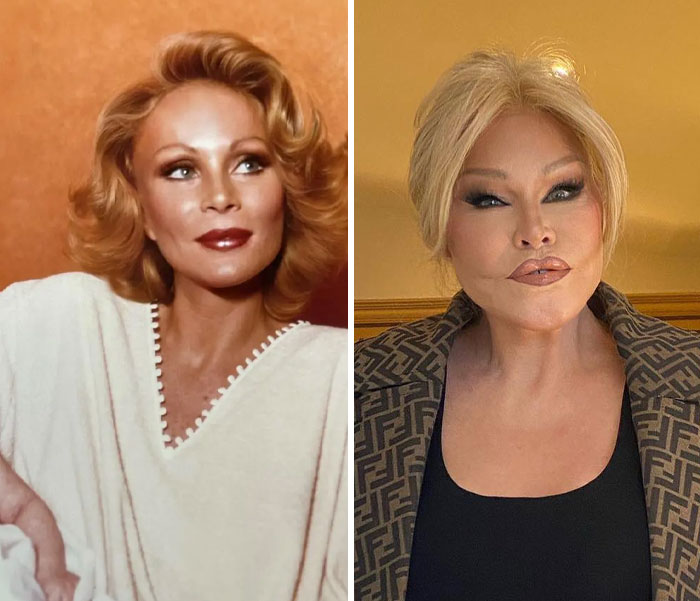 15 Plastic Surgeries That Completely Changed a Celebrity’s Face