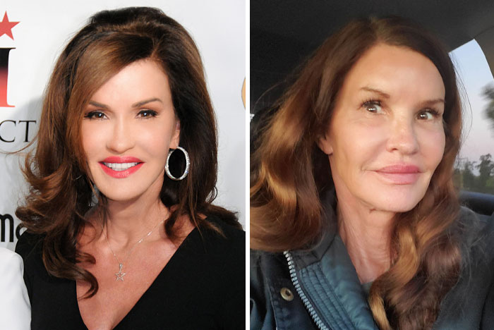 15 Plastic Surgeries That Completely Changed a Celebrity’s Face