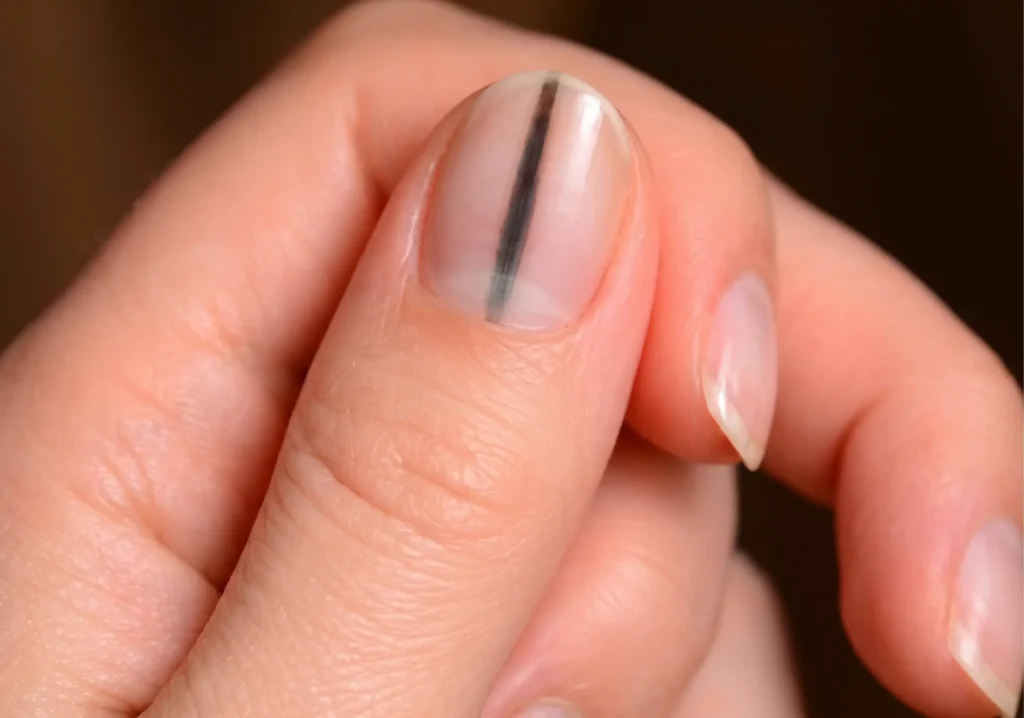 What Lines on Your Nails Really Mean: 7 Possible Causes